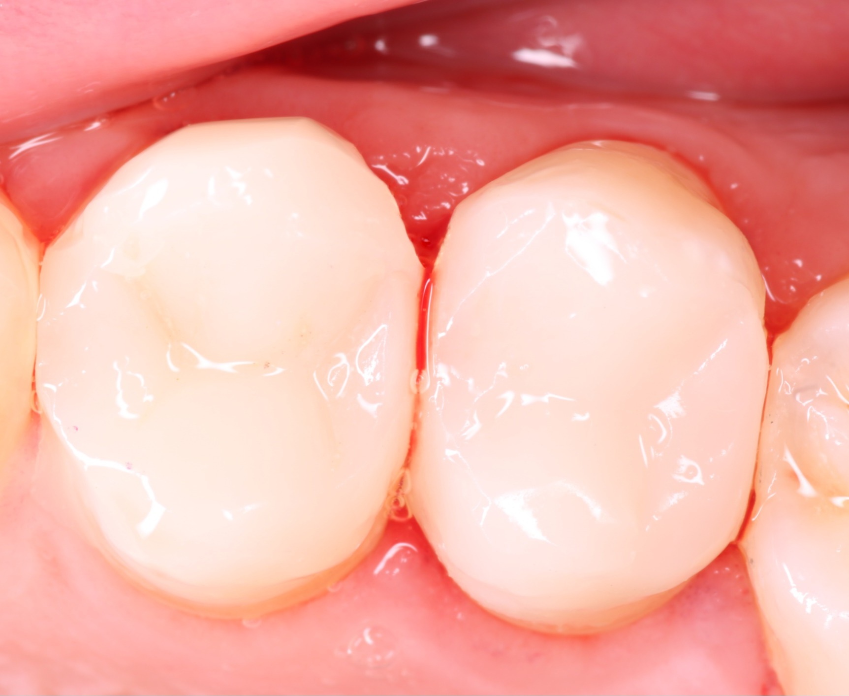 ReelMatrix as a Predictable Tool for Margin Elevation and Core Build-Up Prior to Indirect Restorations